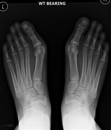 hallux valgus rigidus pdf